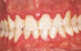 Gingivitis Cure Island Dental PA. Hallandale Beach, Florida 33009